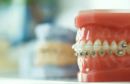 Early Orthodontic Treatment