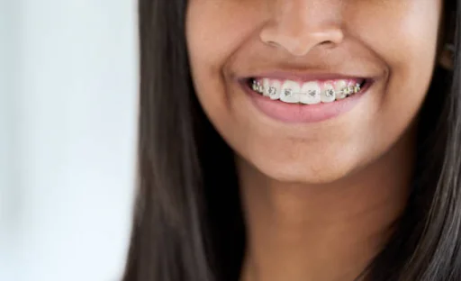 Cost of Braces