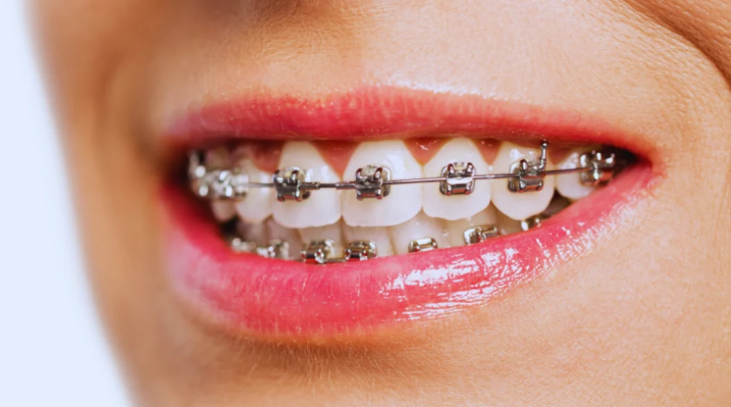 Top Orthodontic Treatment Options in St. Petersburg for 2026