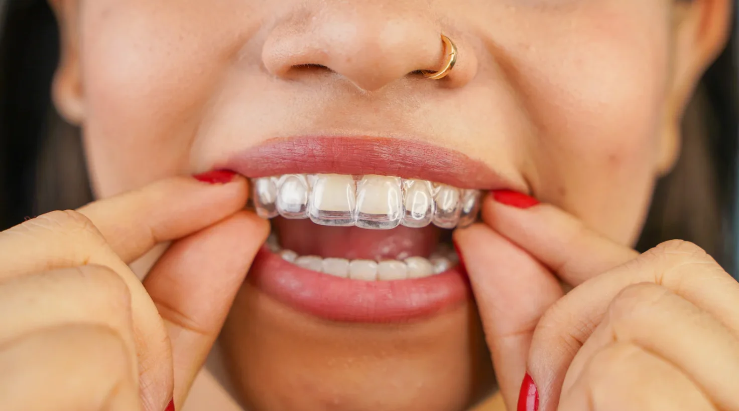 Who Is the Best Orthodontist Near Seminole, FL?