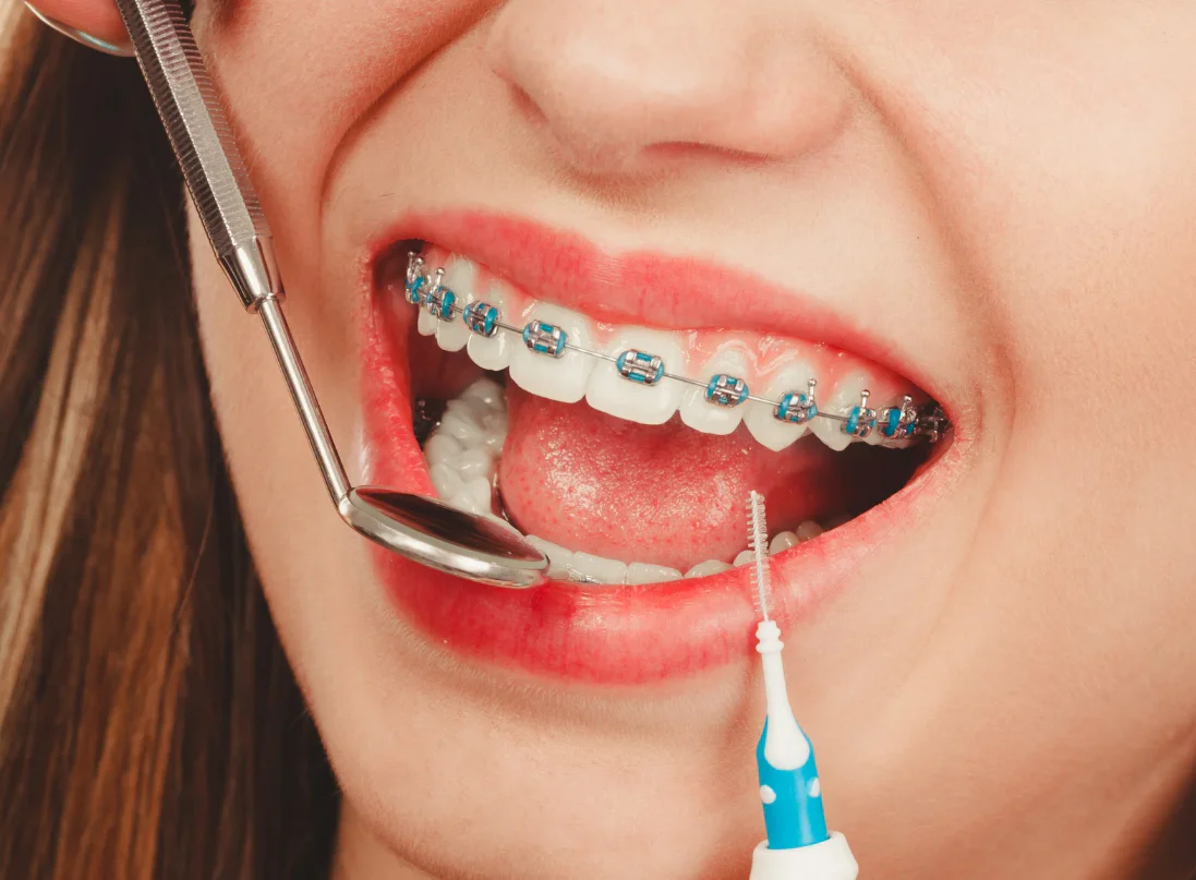 How Much Do Braces Cost in Seminole, FL?