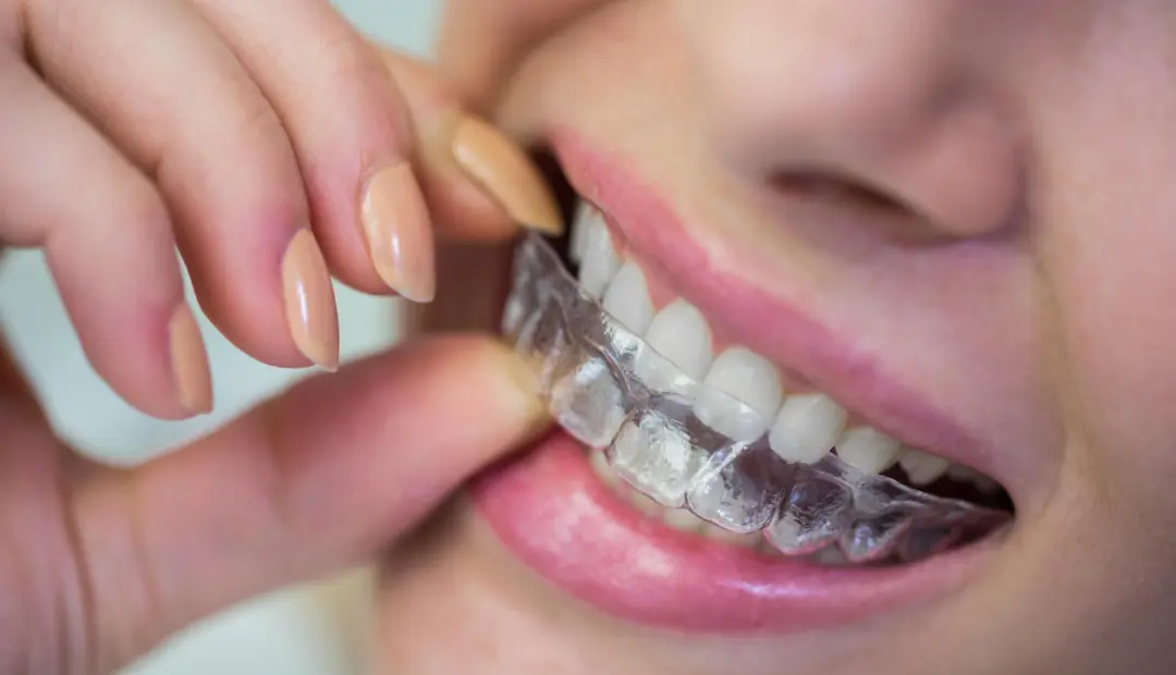 Invisalign for Adults Average Cost and Financing Options! (1)