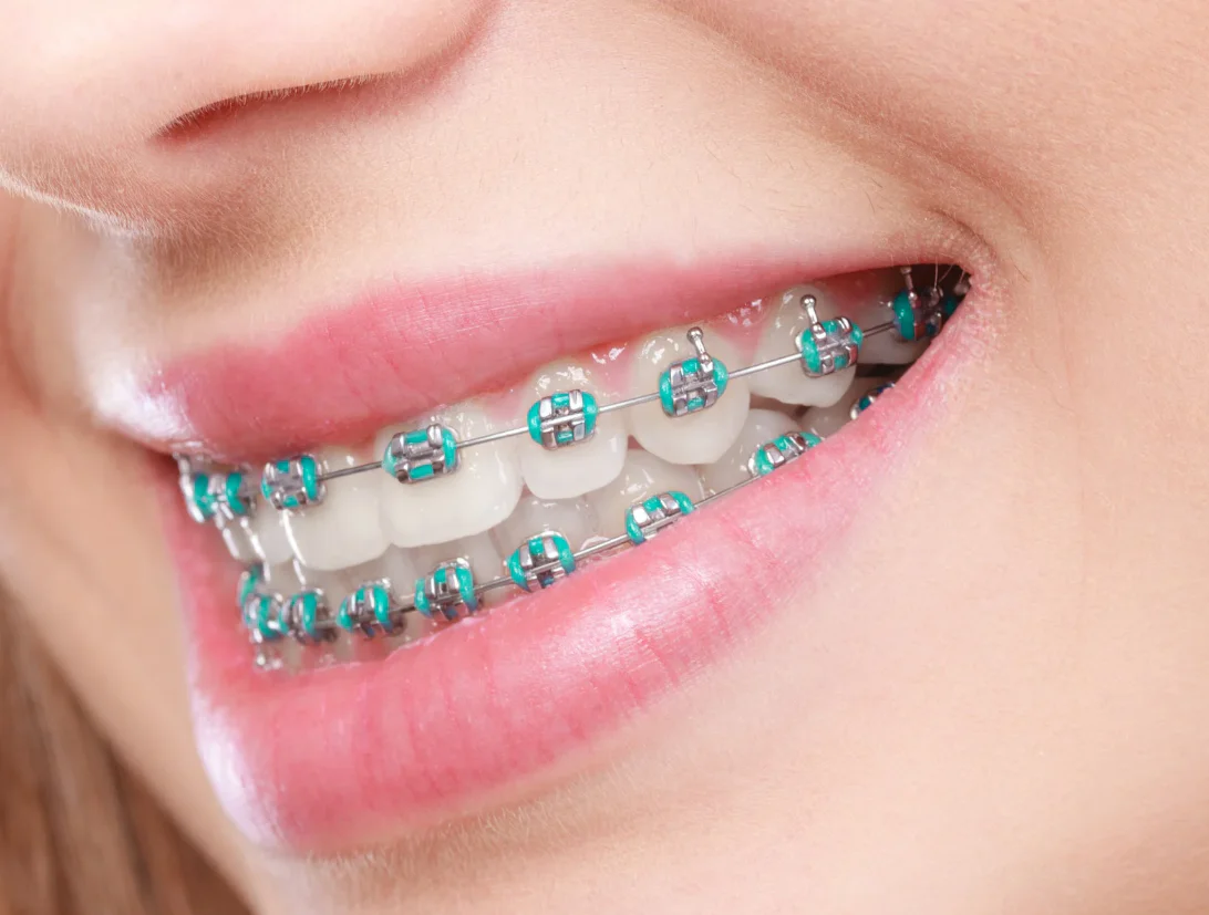 Ceramic vs Metal Braces: What’s the Difference?