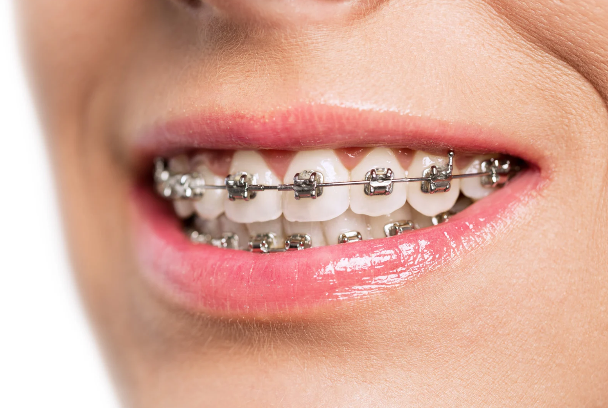 How Much Do Metal Braces Cost in St. Petersburg, FL?