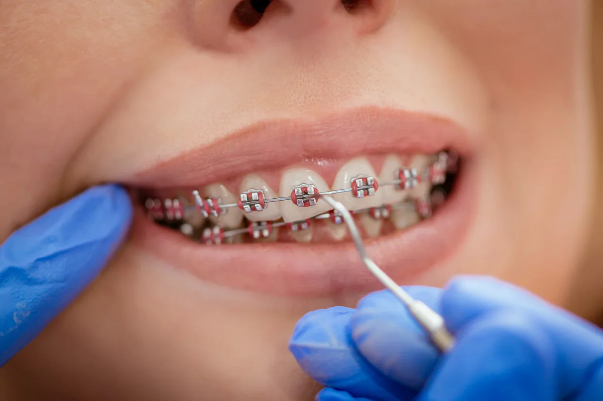 an You Pay for Metal Braces With a Payment Plan?